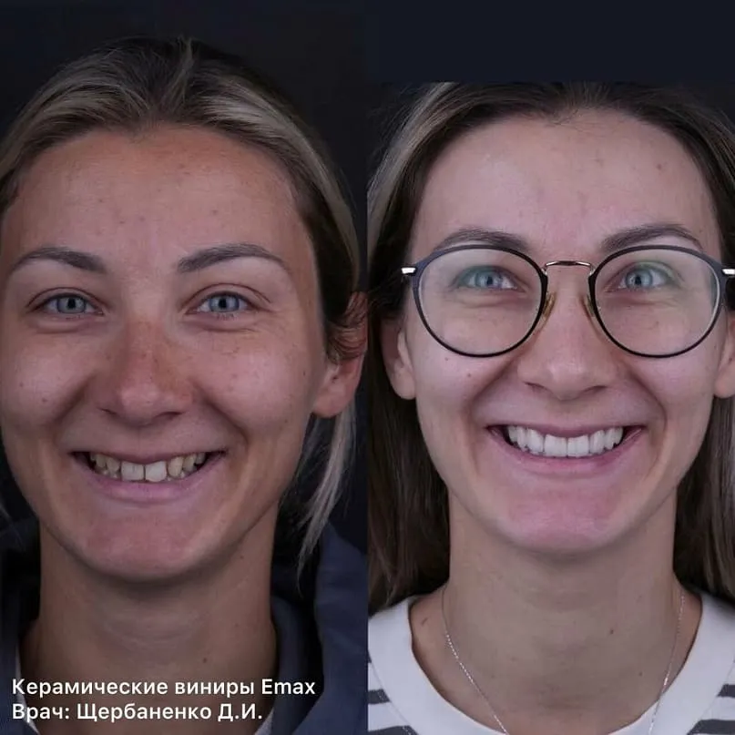 Реставрация на винирах